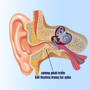 Xương tai thay đổi